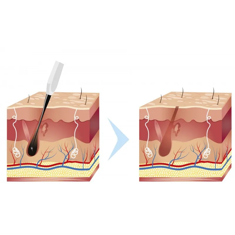 Аппарат для электроэпиляции Epil Ultimate N-01